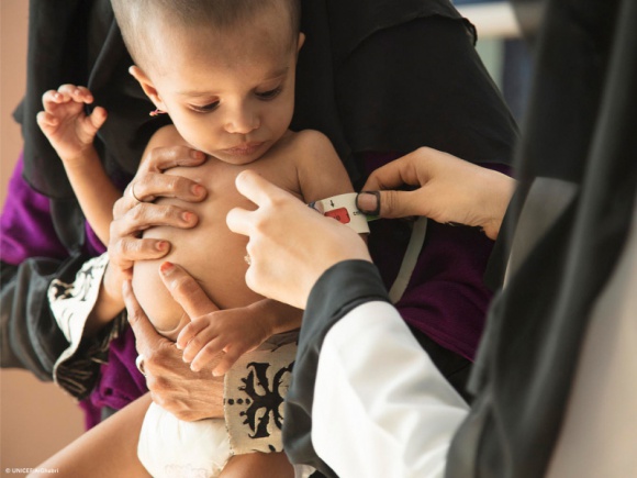 80% dzieci w Jemenie wymaga pomocy humanitarnej. Najmłodsi umierają z głodu